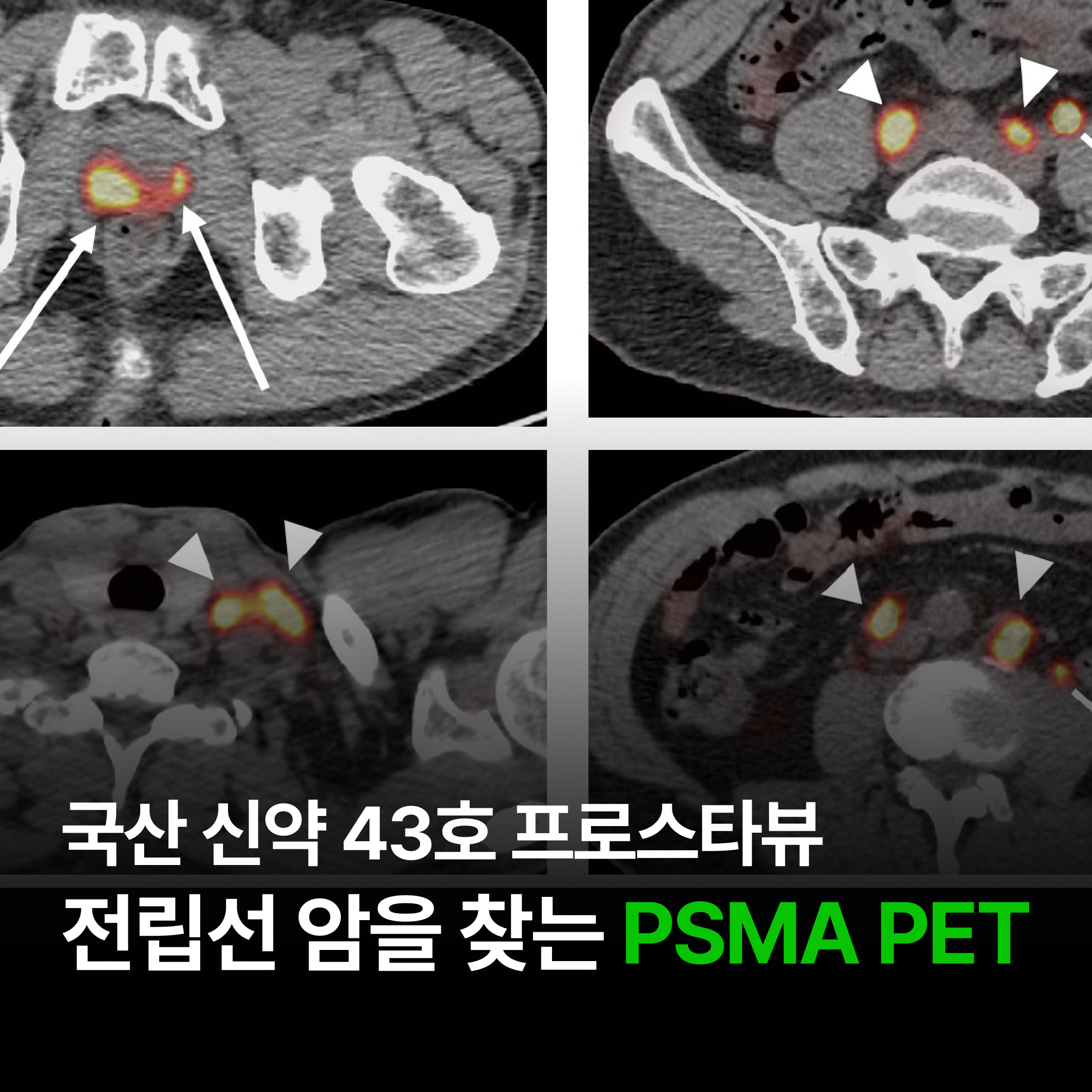 [물리학] 양전자 소멸로 전립선암을 찾는 : F-18 PSMA PET 프로스타뷰